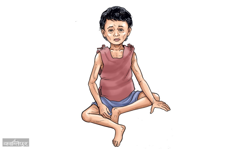 नेपालमा बालबालिकामा हुने पुड्कोपनमा उल्लेखनीय सुधार